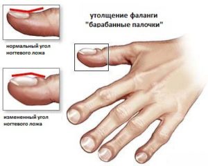 кистозный фиброз муковисцидоз
