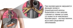 муковисцидоз лечение