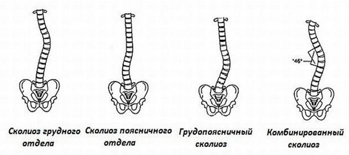 сколиоз позвоночника